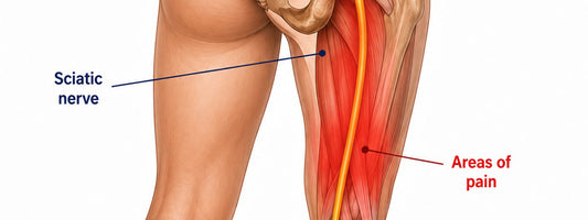 Sciatica diagram showing the sciatic nerve running from the lower back down the leg